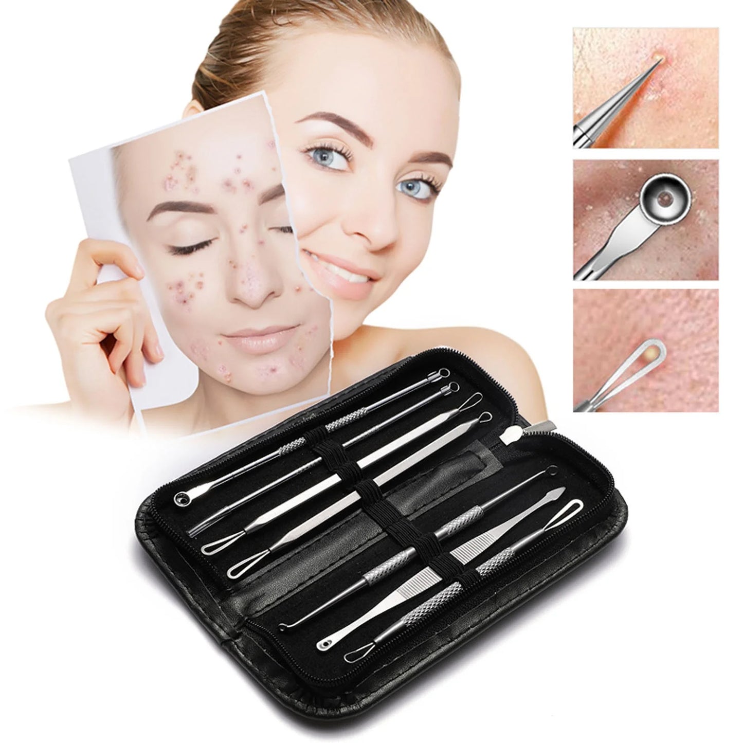 KIT REMOVEDOR EXTRACTOR PUNTOS NEGROS ESPINILLAS ACNÉ 4 PIEZAS FULL